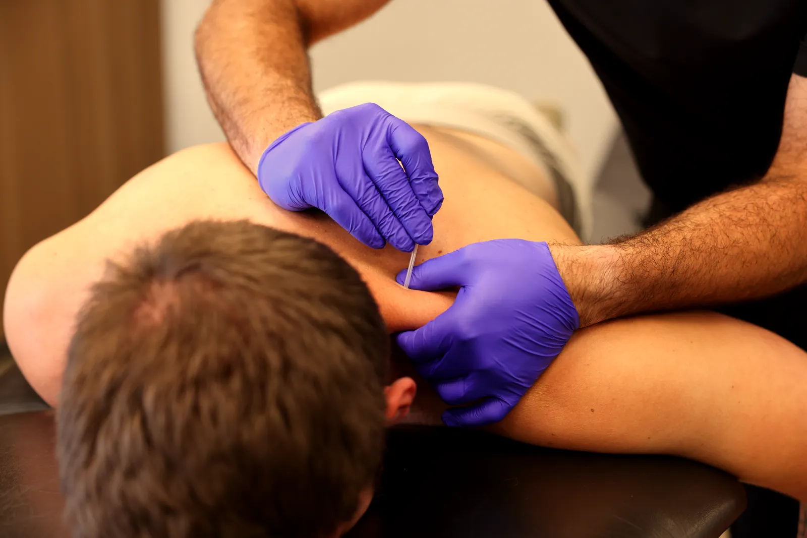 Physiotherapist inserting a dry needle into a patient's shoulder.